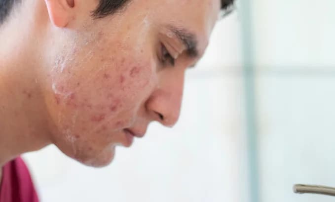 Does Tadalafil Cause Acne?