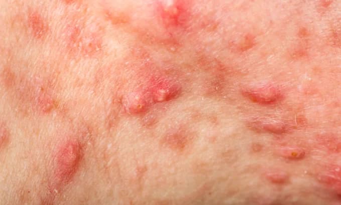 Enclomiphene and Acne: Exploring the Connection