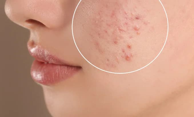 Exploring the Impact of Tirzepatide on Acne
