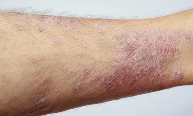 Exploring the Potential of Rapamycin in the Treatment of Psoriasis