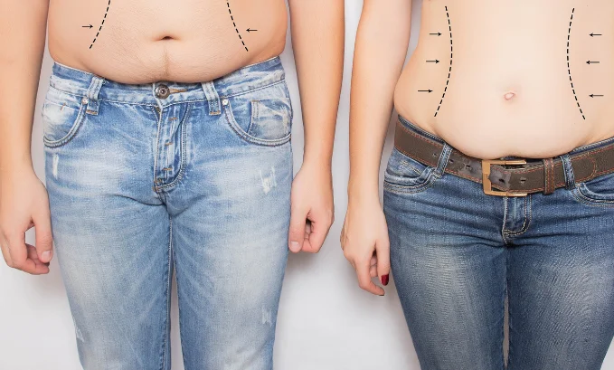 Tirzepatide vs Semaglutide weight loss