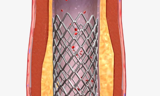 abdominal fat accumulation
