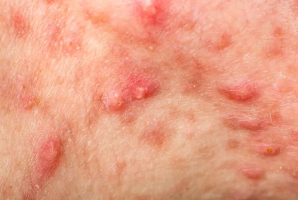 testosterone replacement therapy