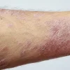 psoriatic lesions